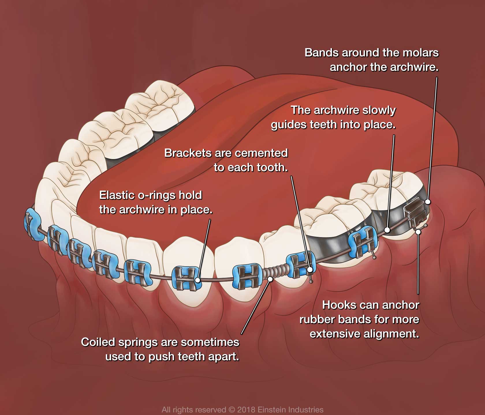 Braces illustration